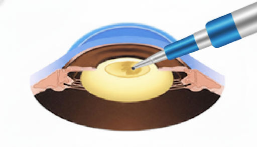 濁った水晶体を砕いて取り出す